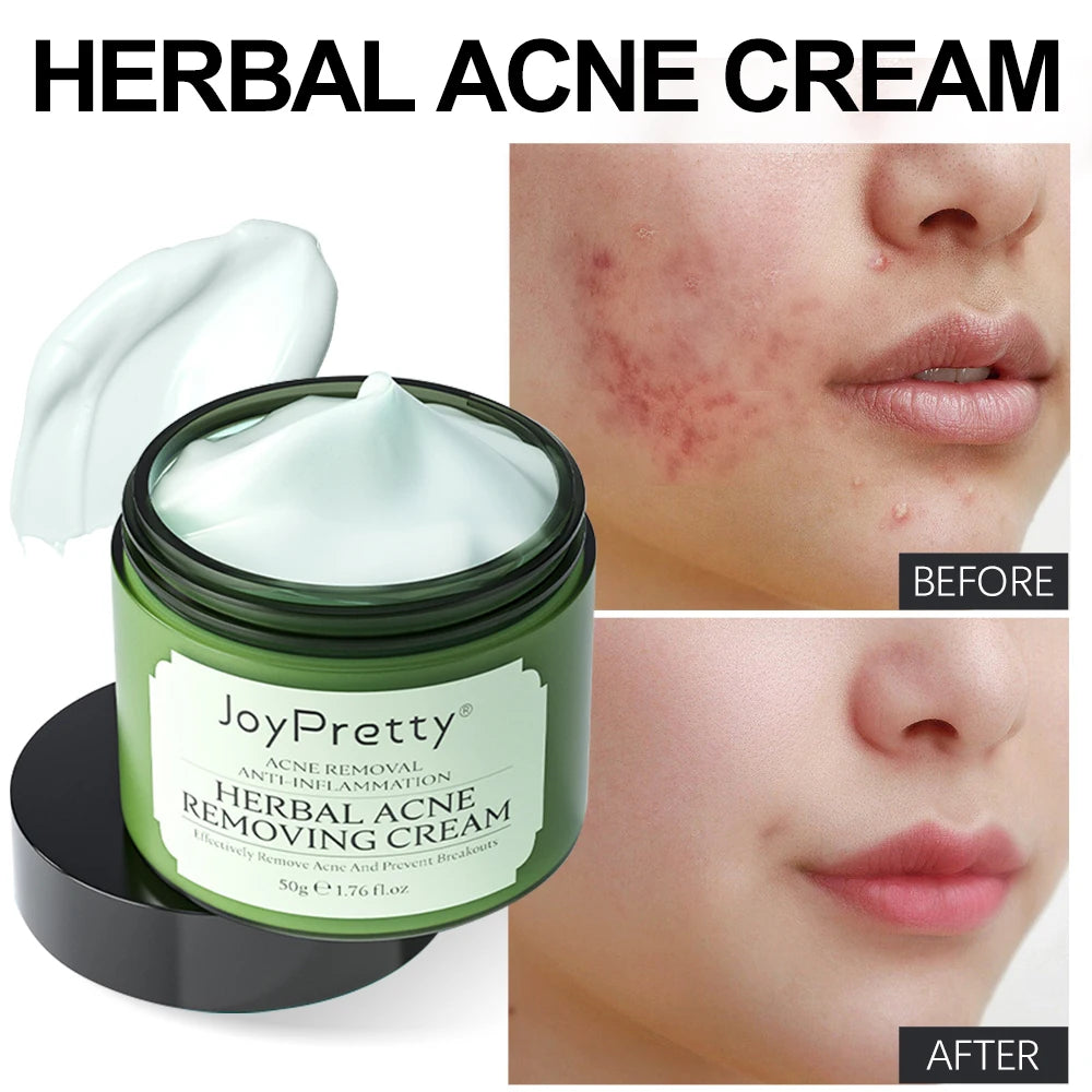 Natural Herbal Acne Treatment Face Cream - Accessory Monk