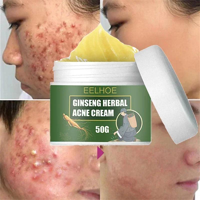 Ginseng Herb Acne Removal Cream - Accessory Monk